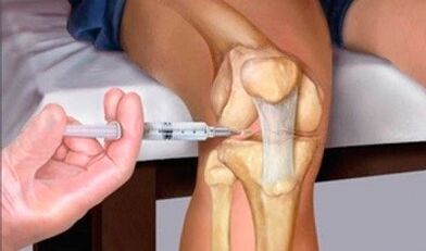 Hyaluronic acid with knee arthrosis joint