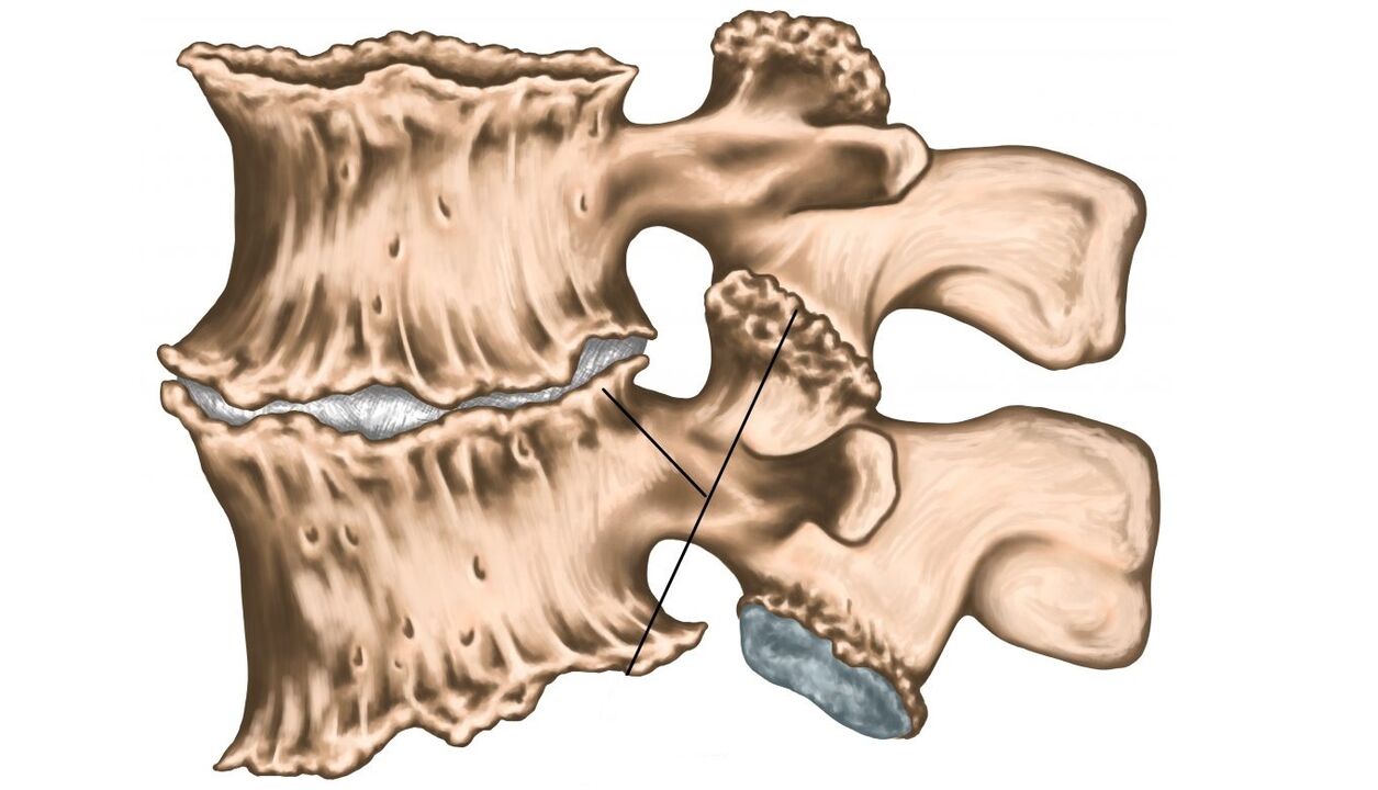 lesions of the spine due to osteochondrosis