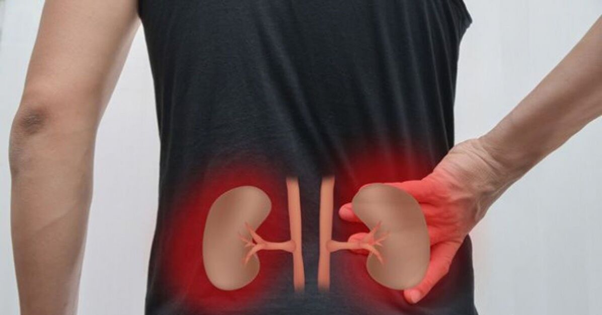 Kidney inflammation can cause lower back pain