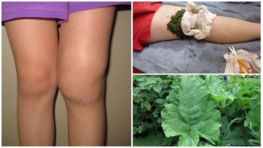 Compress on the knee with burdock - a folk method for the treatment of gonarthrosis