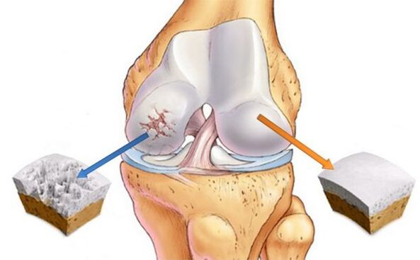 Knee osteoarthritis (left) and normal cartilage (right)