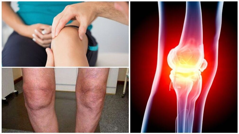 Symptoms of arthrosis of the knee joint