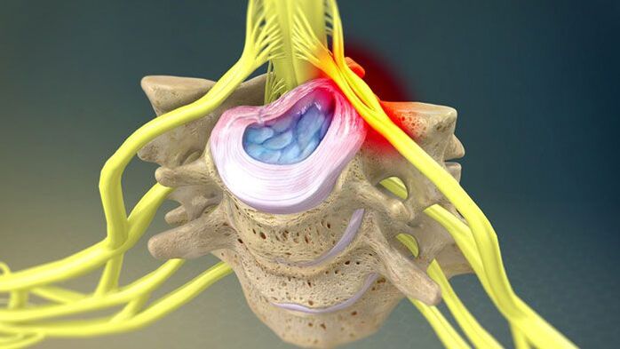 Bulging of the intervertebral discs causes neck pain