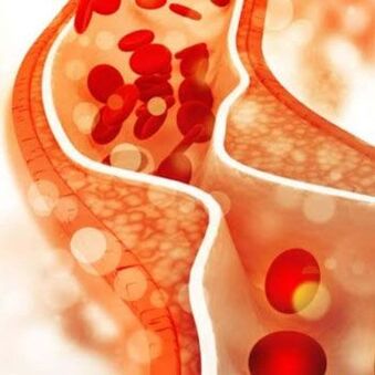 The deposition of cholesterol on the inner walls of the blood vessels provokes pain in the side of the neck